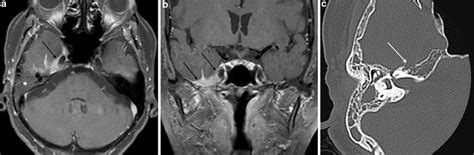 Bone Tumours | Radiology Key