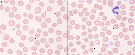 Acanthocytes versus Echinocytes | eClinpath