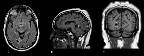 Brain MRI with and without contrast revealed haemosiderin (white... | Download Scientific Diagram