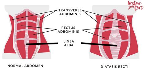 Restore Your Core Publishes: “Diastasis Recti Symptoms” | Syndiket Marketing | SEO, Adwords, Web ...