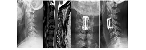 Radiographic study of a 41-year-old woman (patient #3). (A) Plain ...