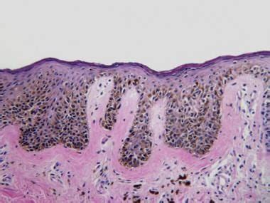 Dysplastic Nevus Histology