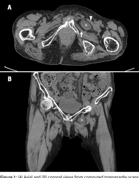 Figure 1 from Obturator hernia | Semantic Scholar