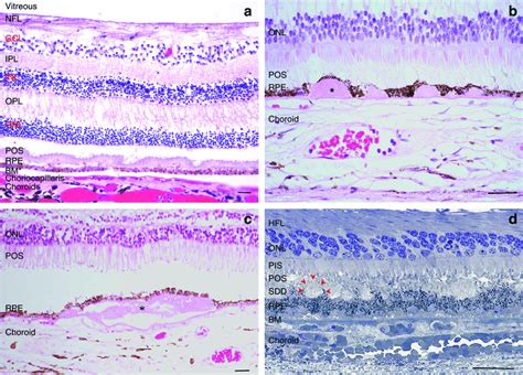 Histological cross-section of a human macula. a Normal macula. b Hard ...