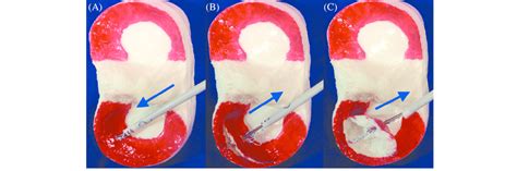 Schematic illustration of the repair of bucket-handle tears with the... | Download Scientific ...