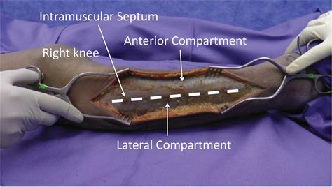 Left Leg Fasciotomy