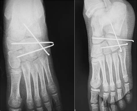 Cuboid nutcracker fracture in a 9-year-old child | BMJ Case Reports