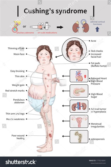 Cushings Syndrome Cause Symptoms Medical Illustration Stock ...