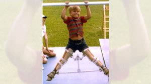 Overcoming Perthes: Cameron Mathison Goes From Leg Braces to 'Dancing ...