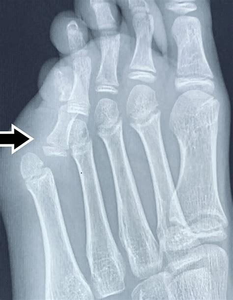 Cureus | A Rare Case of Neglected Fifth Metatarsophalangeal Joint ...