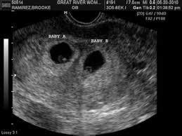 Yolk sac and fetus or twins? - BabyCenter