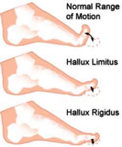 Hallux Limitus - Sydney Foot Clinic