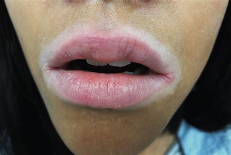 Perioral Köebner Phenomenon Following Lip Licking Dermatitis in a ...