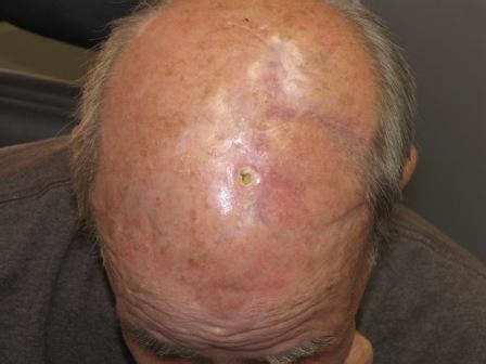 Scalp Radiation for High Risk Skin Cancer – The Perils and the Perfect Storm - Skin Cancer and ...