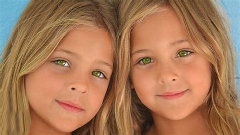 These Twins Were Named "Most Beautiful In The World" Wait Till You See Them Today - Facts Verse