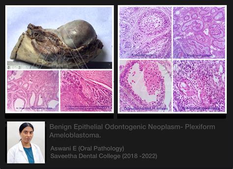 Plexiform Ameloblastoma Histology