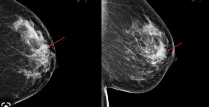 What to Expect During a Diagnostic Mammogram and Ultrasound - USA Drug Guide