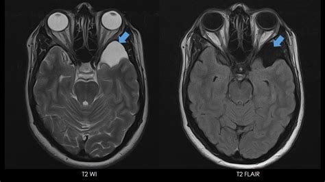 Ultimate Radiology : Intracranial Arachnoid Cyst : Galassi Type I