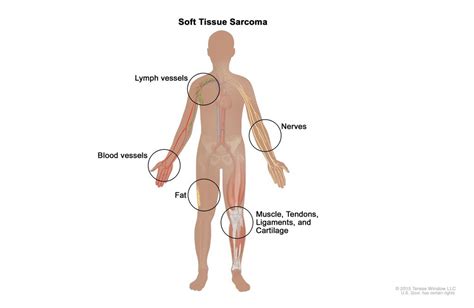 Skeletal Metastasis in Soft Tissue Sarcoma and its Diagnosis - IMAQPRESS || Canadian Publisher ...