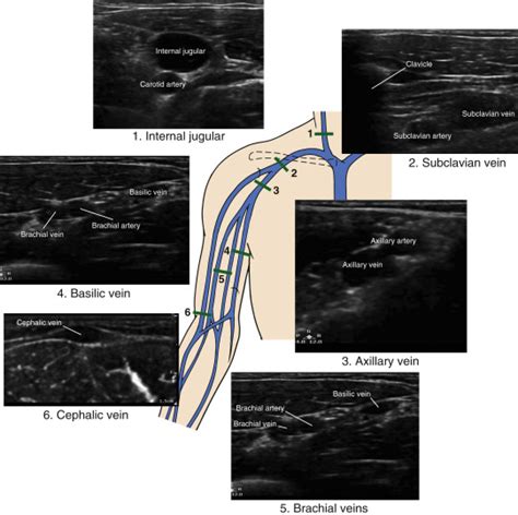 Axillary Vein Cephalic Vein