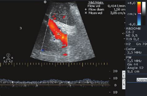 Portal Vein Doppler Ultrasound