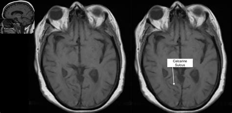 Radiological Anatomy: Calcarine Sulcus - Stepwards