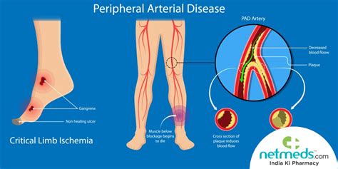 Peripheral Artery Disease Causes, Symptoms and Treatment