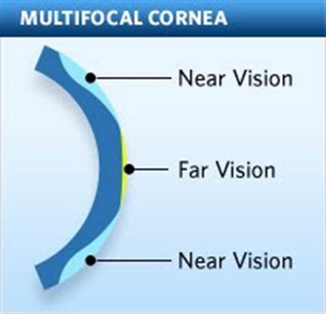 Presbyopia Surgery | NextBigFuture.com