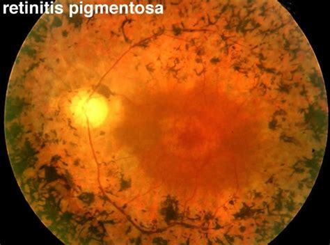 Retinitis pigmentosa causes, symptoms, diagnosis, treatment & prognosis