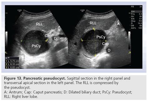 Sagittal Pancreas Ultrasound