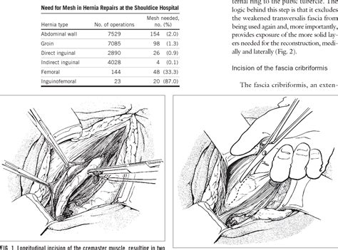 [PDF] The Shouldice technique: a canon in hernia repair. | Semantic Scholar