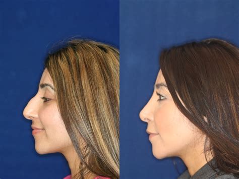 Ethnic Rhinoplasty | Ethnic Nose Job Beverly Hills