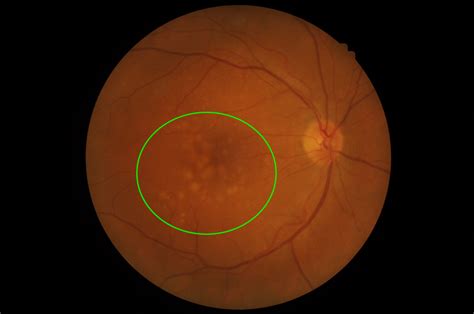 Stages of age-related macular degeneration | Macular Disease Foundation