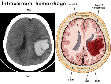 What Is The Meaning Of Intracerebral Hematoma - Beth Mulholland Bruidstaart