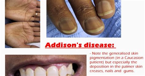 Medical Treatment Pictures-for Better Understanding: Addison’s Disease Diagnosis