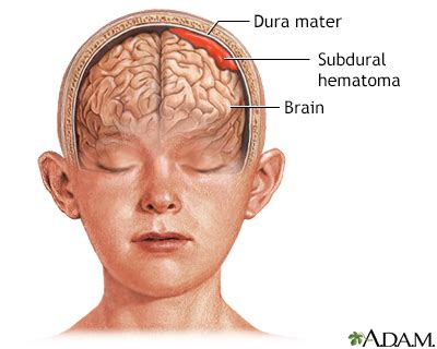 Increased intracranial pressure Information | Mount Sinai - New York