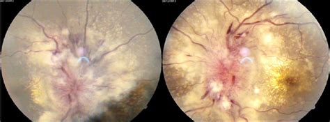 Bilateral exudative retinal detachment in a case of paragang ...