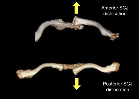 Sternoclavicular Joint Injuries: When to Consider Surgery, And How Is ...