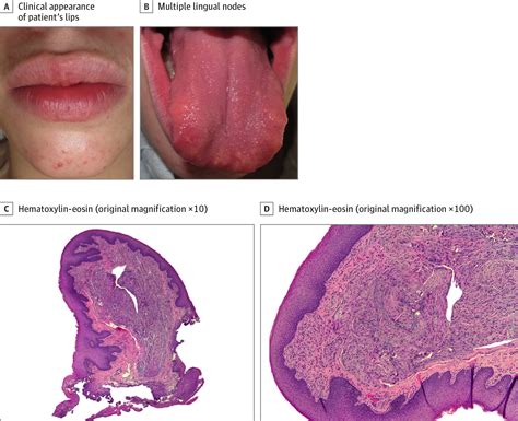 A Girl With Marfanoid Habitus and Distinctive Orolabial Lesions | Dermatology | JAMA Dermatology ...