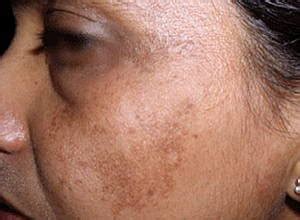 Melasma Facial Pigmentation - Dermatology Sydney