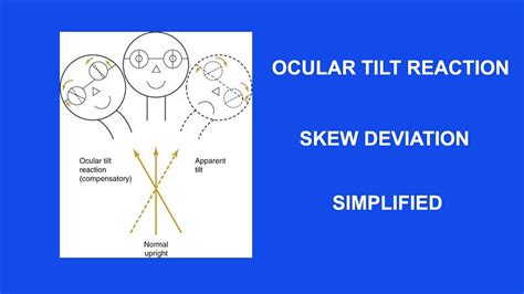 OCULAR TILT REACTION,SKEW DEVIATION SIMPLIFIED - YouTube