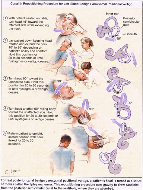 Epley Maneuver | Physical therapy, Physical therapy exercises, Vertigo ...