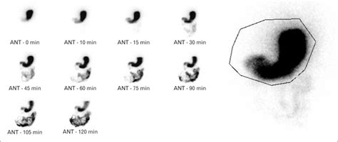 Gastric Emptying Study: St. Elizabeth's Medical Center | Steward Family Hospital | Brighton MA