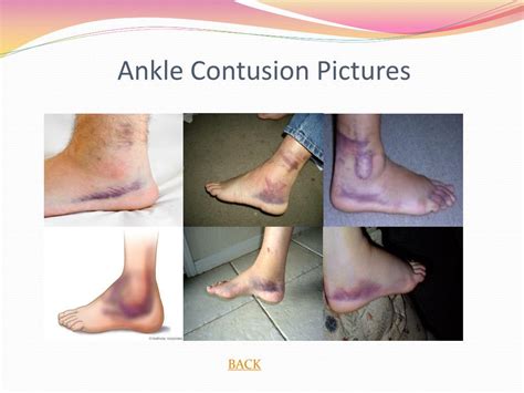 PPT - Ankle Injuries PowerPoint Presentation, free download - ID:6224785