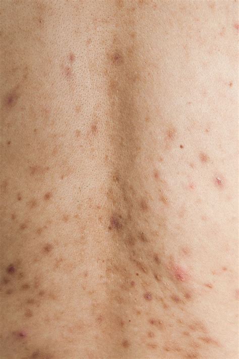 Post-Inflammatory Hyperpigmentation and Acne