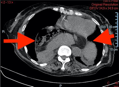 Cureus | Gastric Volvulus: A Multidisciplinary Approach and Conservative Treatment