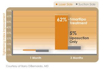 Cynosure SLT II Smartlipo Triplex for Sale | Dr's Toy Store