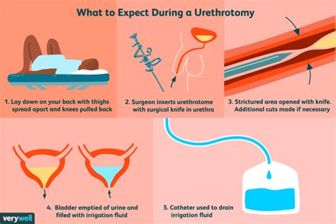 Urethrotomy: Uses, Side Effects, Procedure, and Results