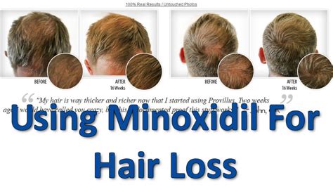 Using Minoxidil for Hair Loss - For Men ONLY - YouTube