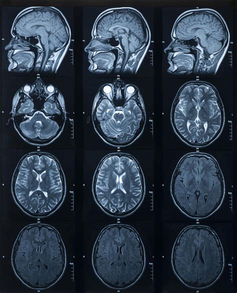 Ultra-High Field MRI Provides a Closer Look of the Hippocampus in Down Syndrome